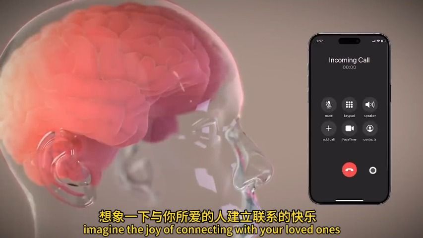 【中英字幕】马斯克脑机接口公司Neuralink人体实验计划Prime study哔哩哔哩bilibili