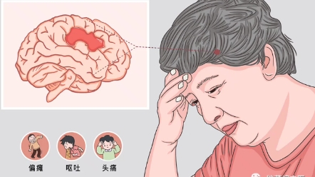 脑血管痉挛的症状 B站