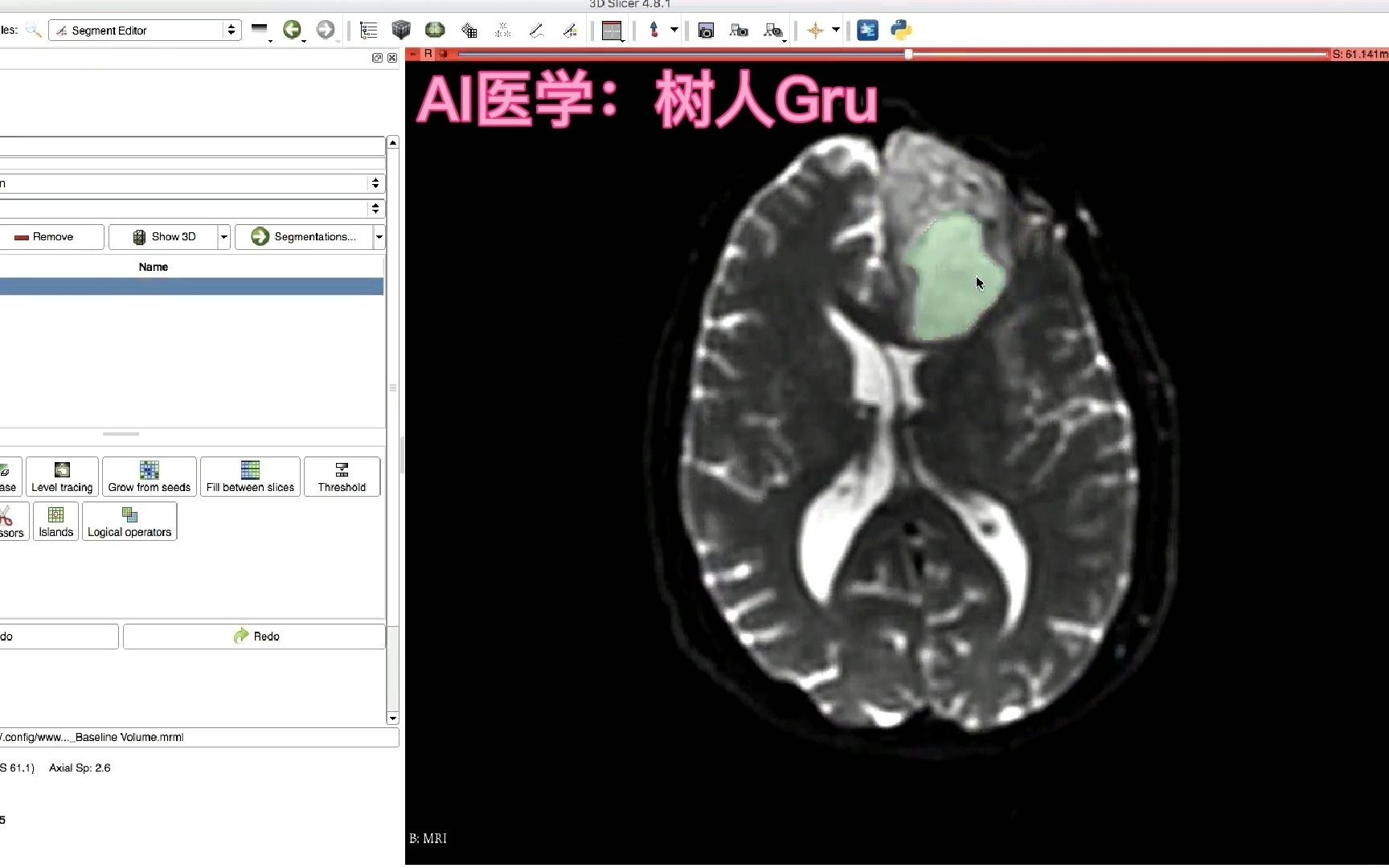 AI医学:基于Slicer的影像组学特征提取哔哩哔哩bilibili