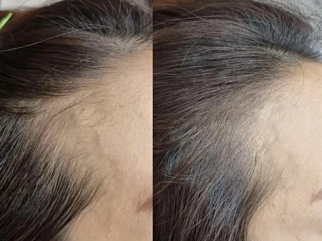 发际线前后对比,看得见的改变!