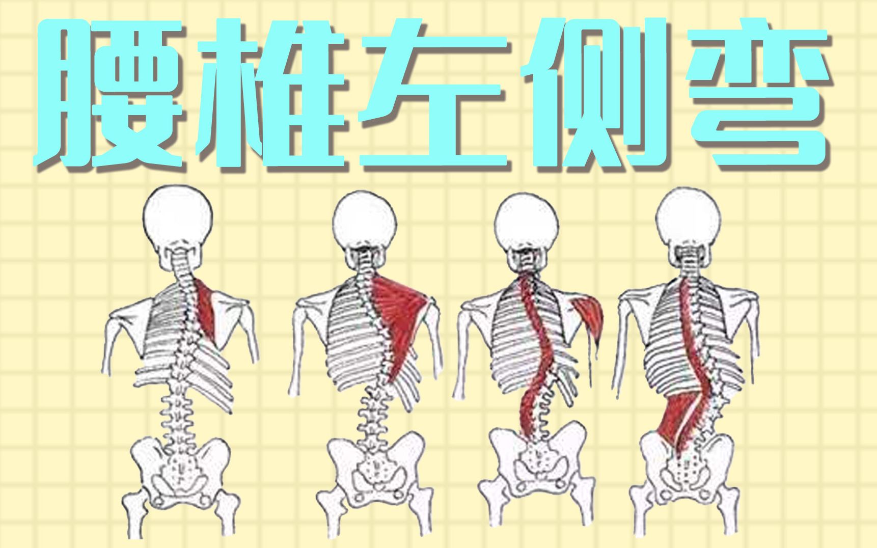脊柱侧弯腰椎篇矫正动作每天15分钟下班在家就可以练习