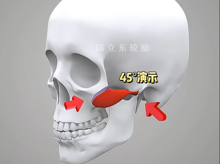 颧骨内推 钛钉图片