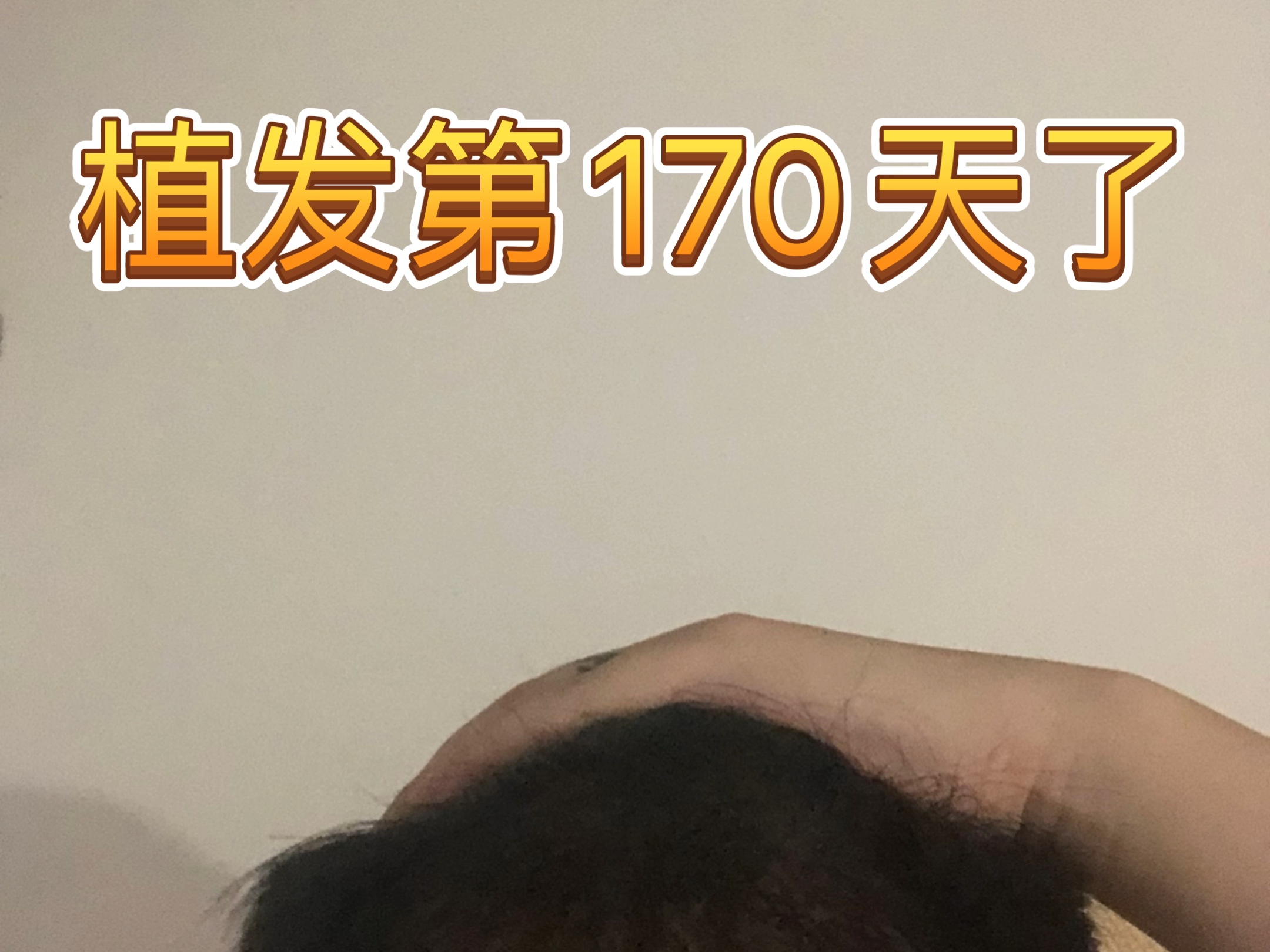 柘城植发便宜(头发植发的一般价格是多少)