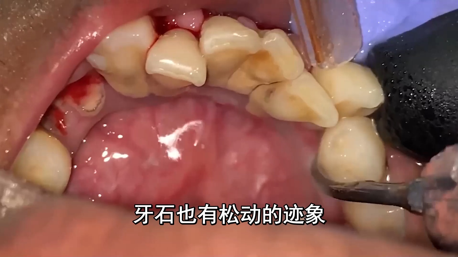 米云牙粉 ndd牙粉 牙粉怎么用 洗牙粉能让牙齿变白吗