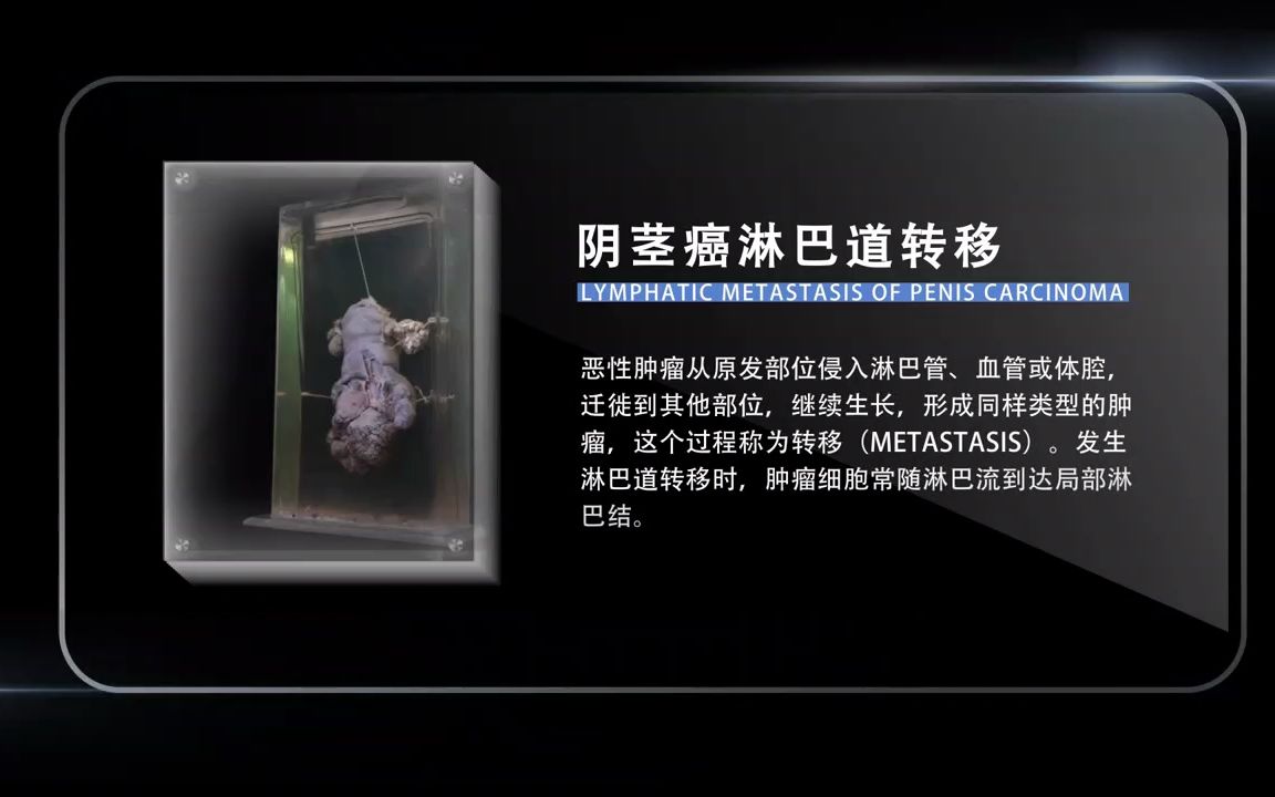 [6.4.3] 病之容颜 阴茎癌淋巴结转移哔哩哔哩bilibili