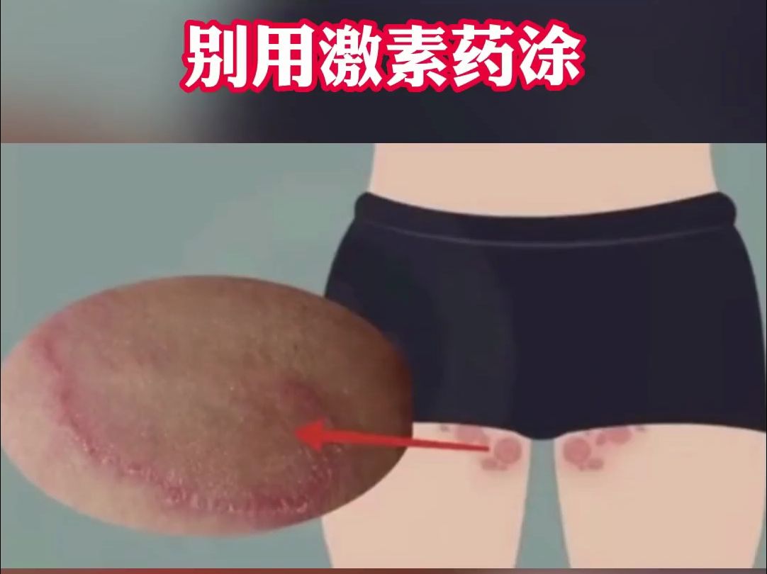 大腿内侧起红斑瘙痒的千万要注意了!会传染!哔哩哔哩bilibili