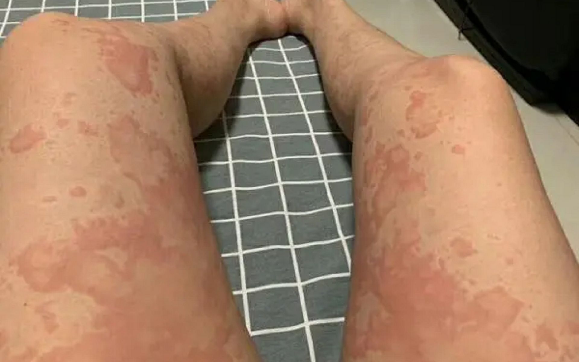 荨麻疹又痒又反复?方法用对轻松缓解【风团】折磨,早学早受益!