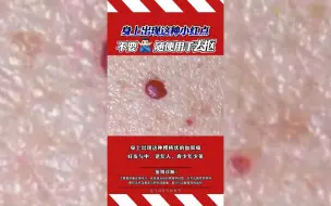 下载视频: 身上出现这种小红点，千万别用手去抠