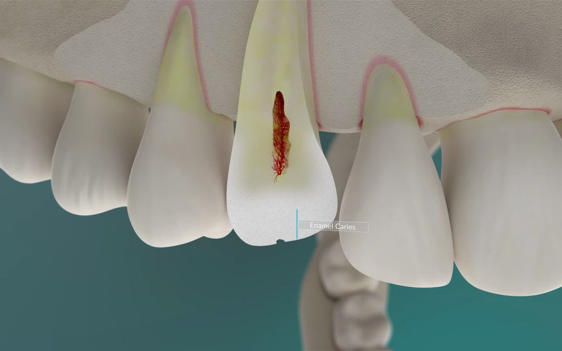 [图]Prevent Caries & Periodontitis - Dental Health Recommendations (Animation)