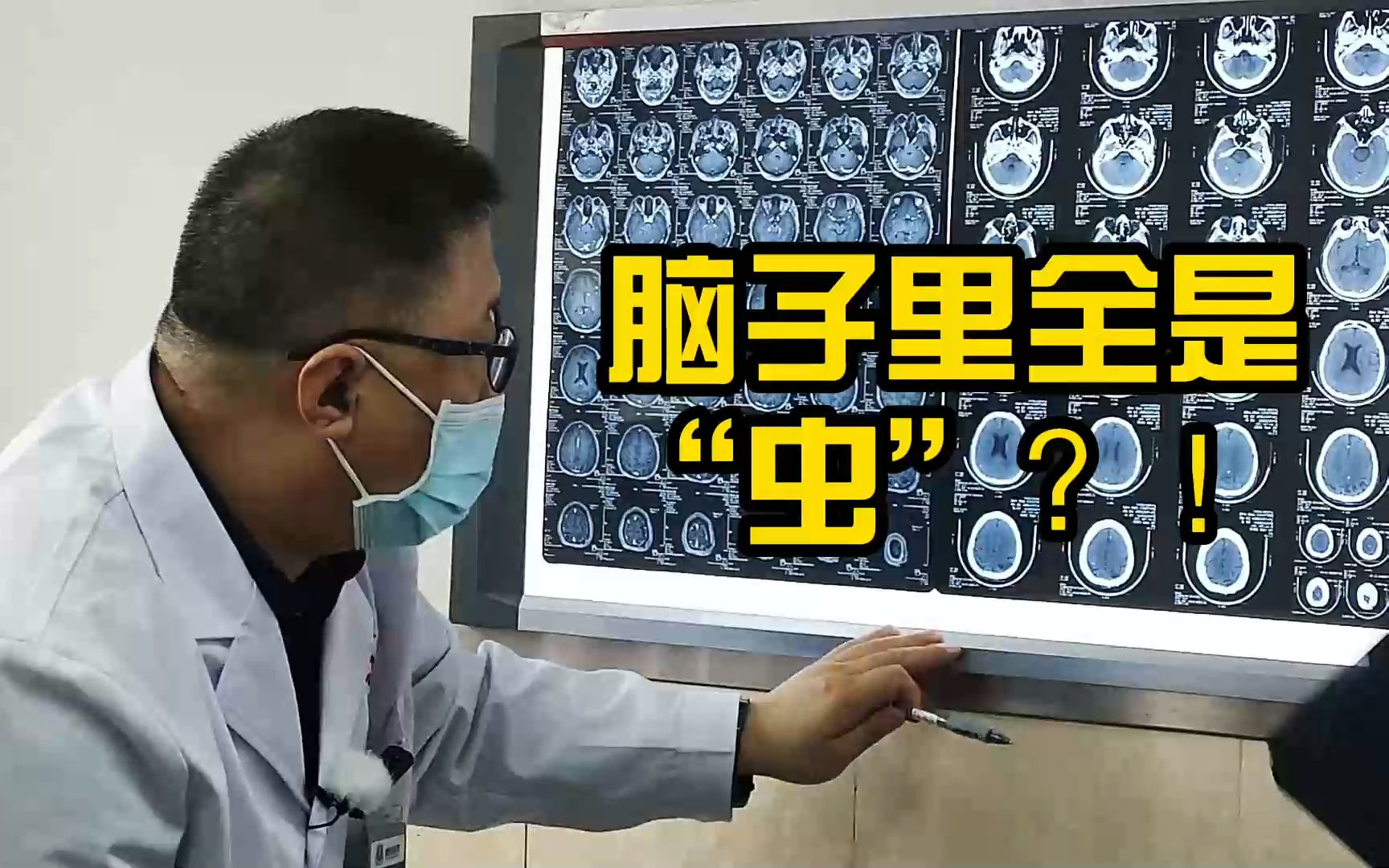 男子得腦囊蟲病,腦子裡全是