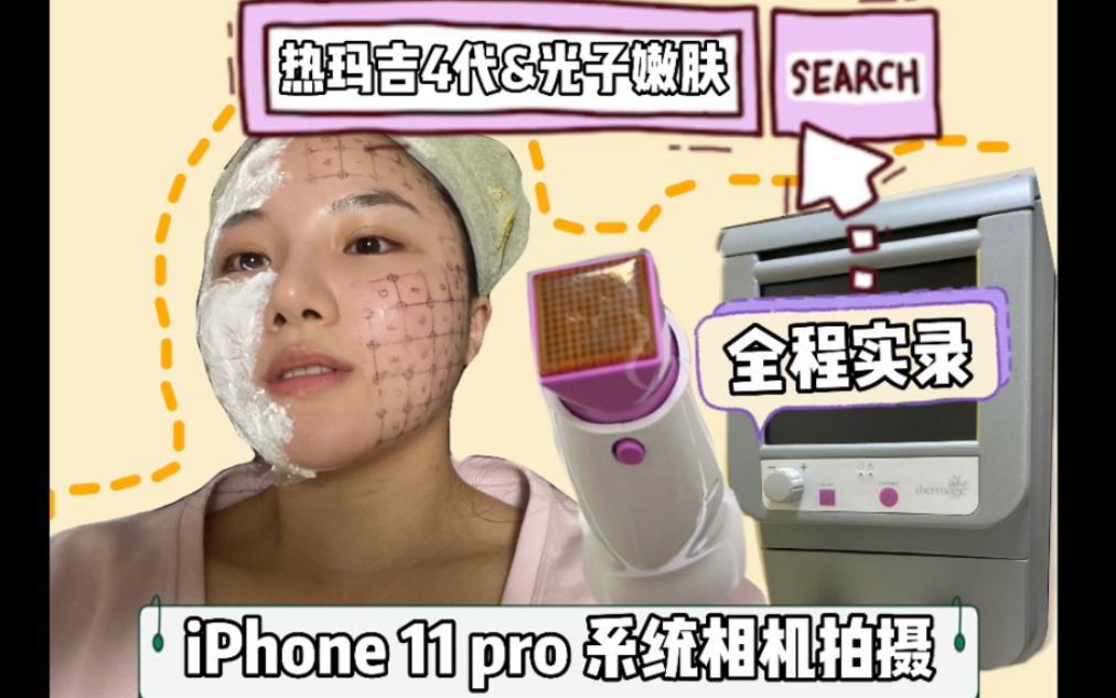 【医美抗衰】热玛吉4代全记录