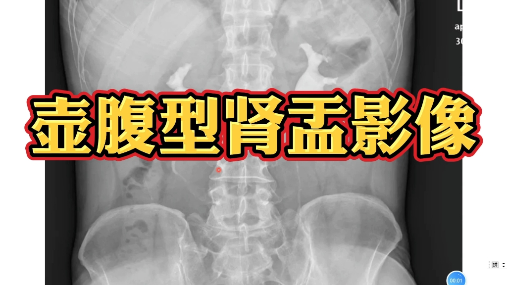 壶腹型肾盂在影像学上什么表现?如何诊断和鉴别?哔哩哔哩bilibili