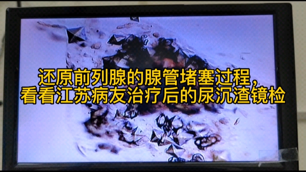 还原前列腺腺管的堵塞过程,看看江苏前列腺炎病友治疗后的尿沉渣镜检.哔哩哔哩bilibili