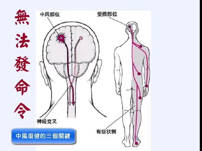 中风康复的三个关键哔哩哔哩bilibili