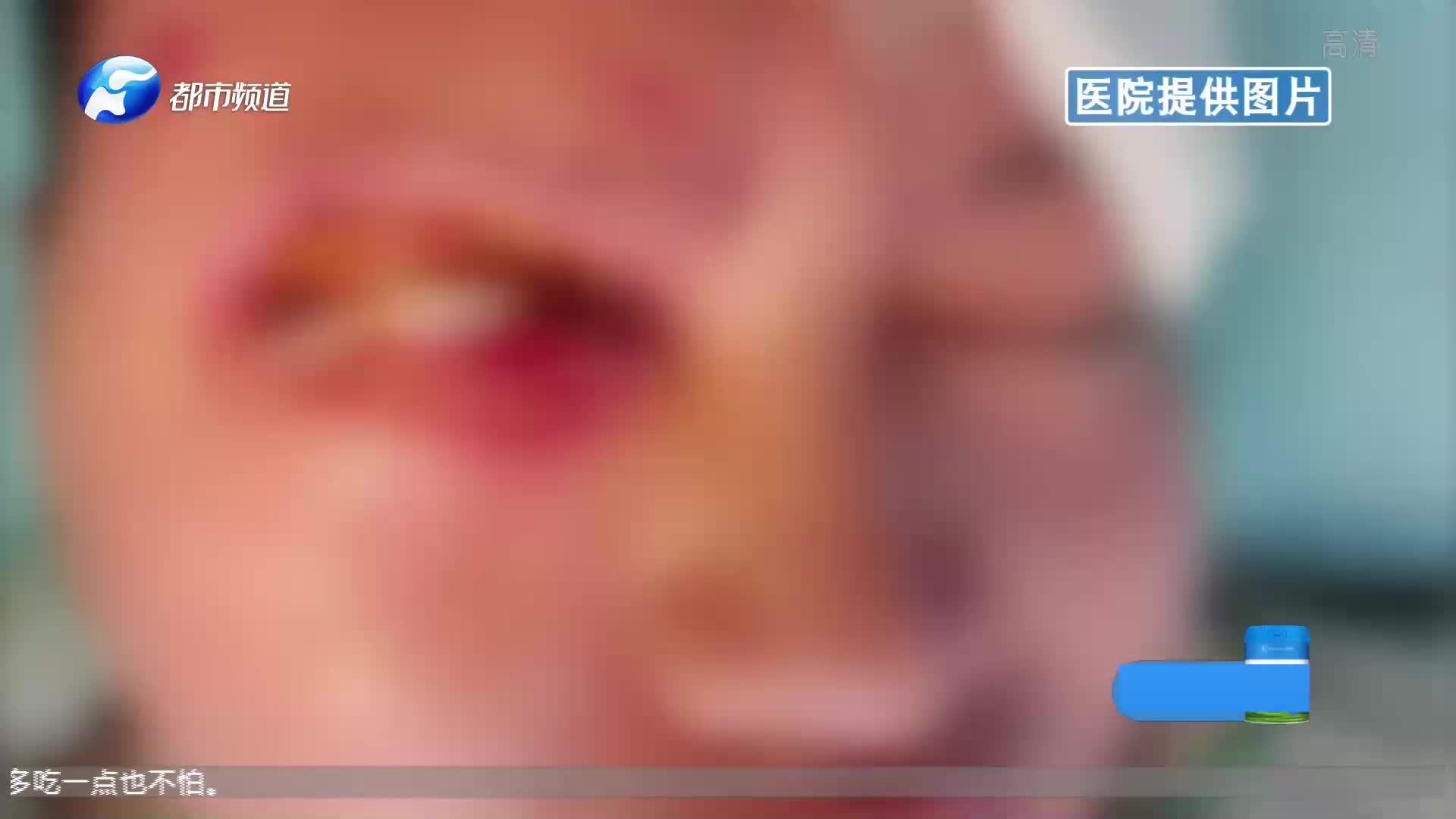 手机充电器爆炸,击穿男子眼睑右眼失明,男子:地摊买的便宜货哔哩哔哩bilibili