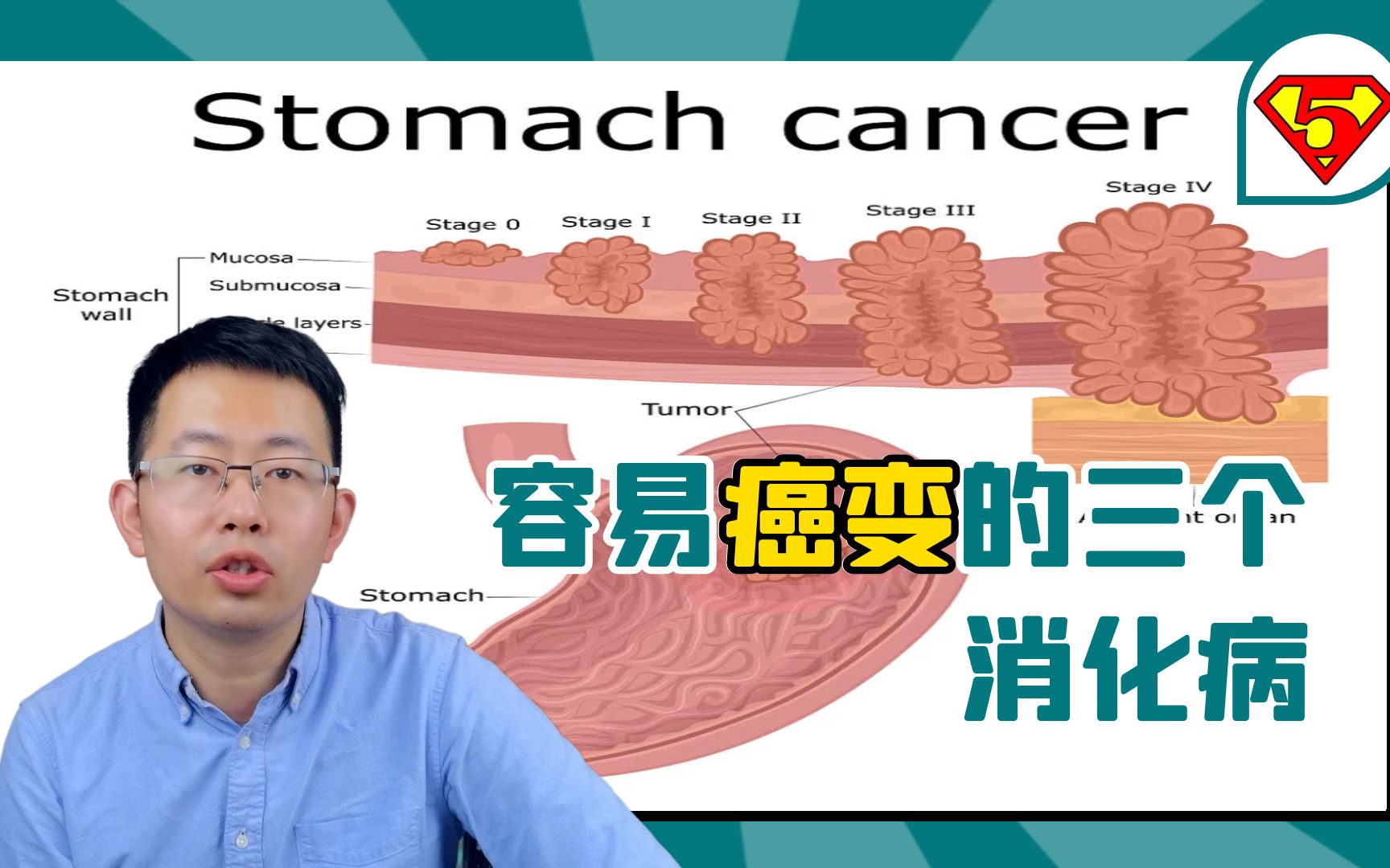 这三个消化病容易癌变,有基础病变的人尤其要注意,及时阻断病程哔哩哔哩bilibili