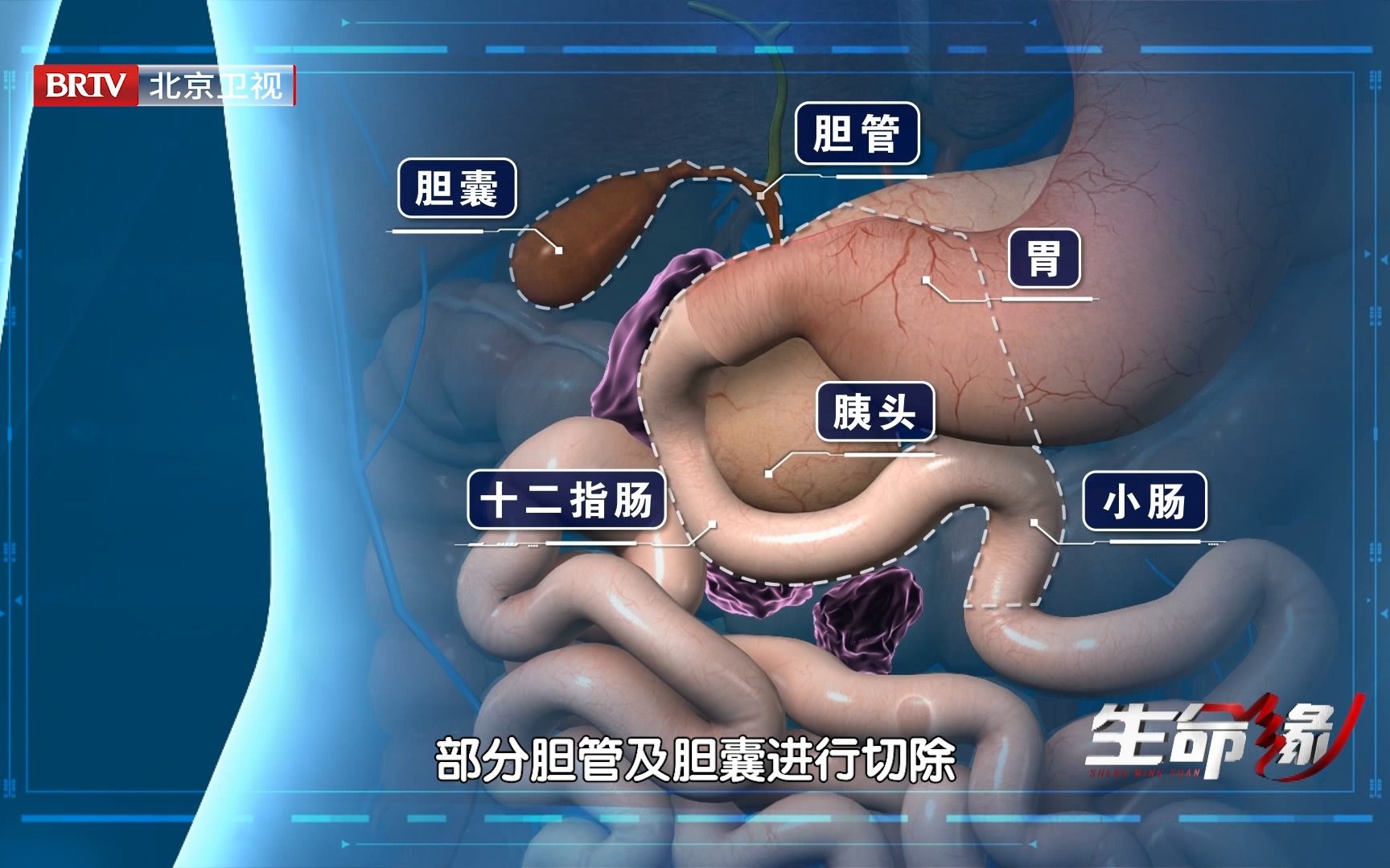 能否在保留器官的前提下,做到肿瘤全切?郝主任精益求精,不想给患者留隐患(15)哔哩哔哩bilibili