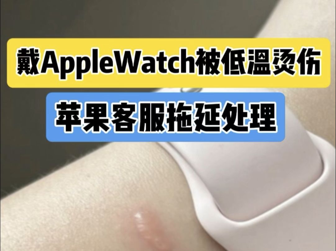 戴Apple Watch被低温烫伤 苹果客服拖延处理哔哩哔哩bilibili