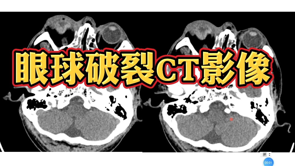 眼球破裂伴晶状体脱位CT表现分享,初学者收藏!哔哩哔哩bilibili