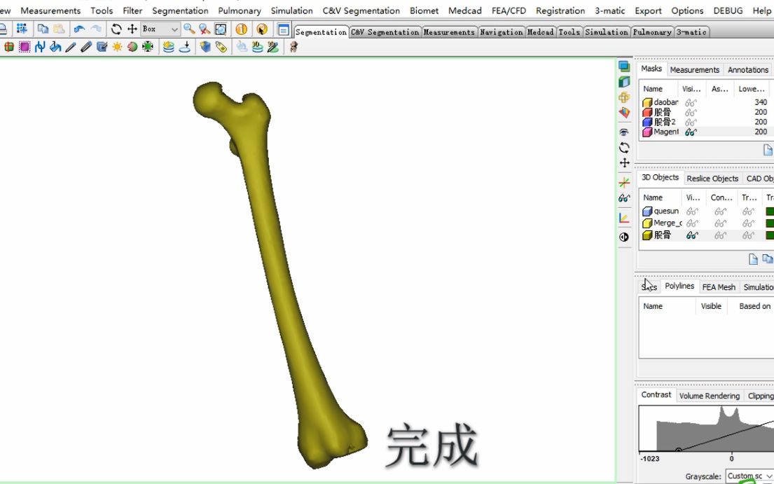 MIMICS提取股骨哔哩哔哩bilibili