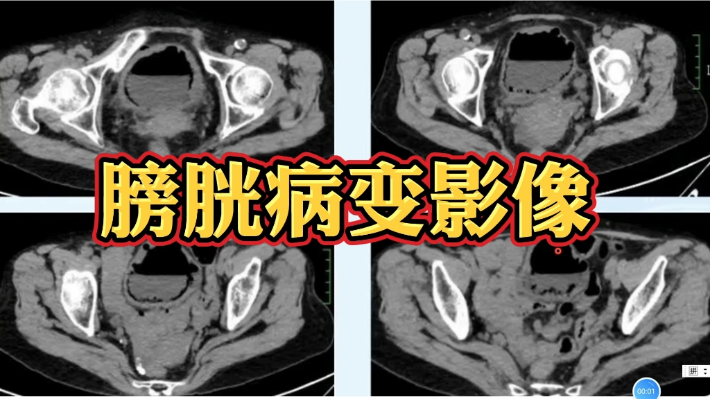 老年女性,CT提前膀胱壁多发积气,如何诊断?哔哩哔哩bilibili