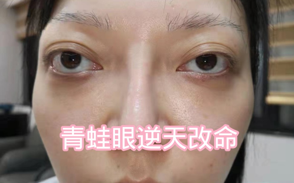 23年青蛙眼的逆天改命之旅