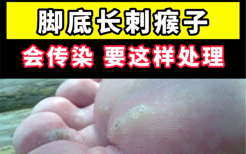 脚底长刺瘊子,尽快处理,因为会传染!