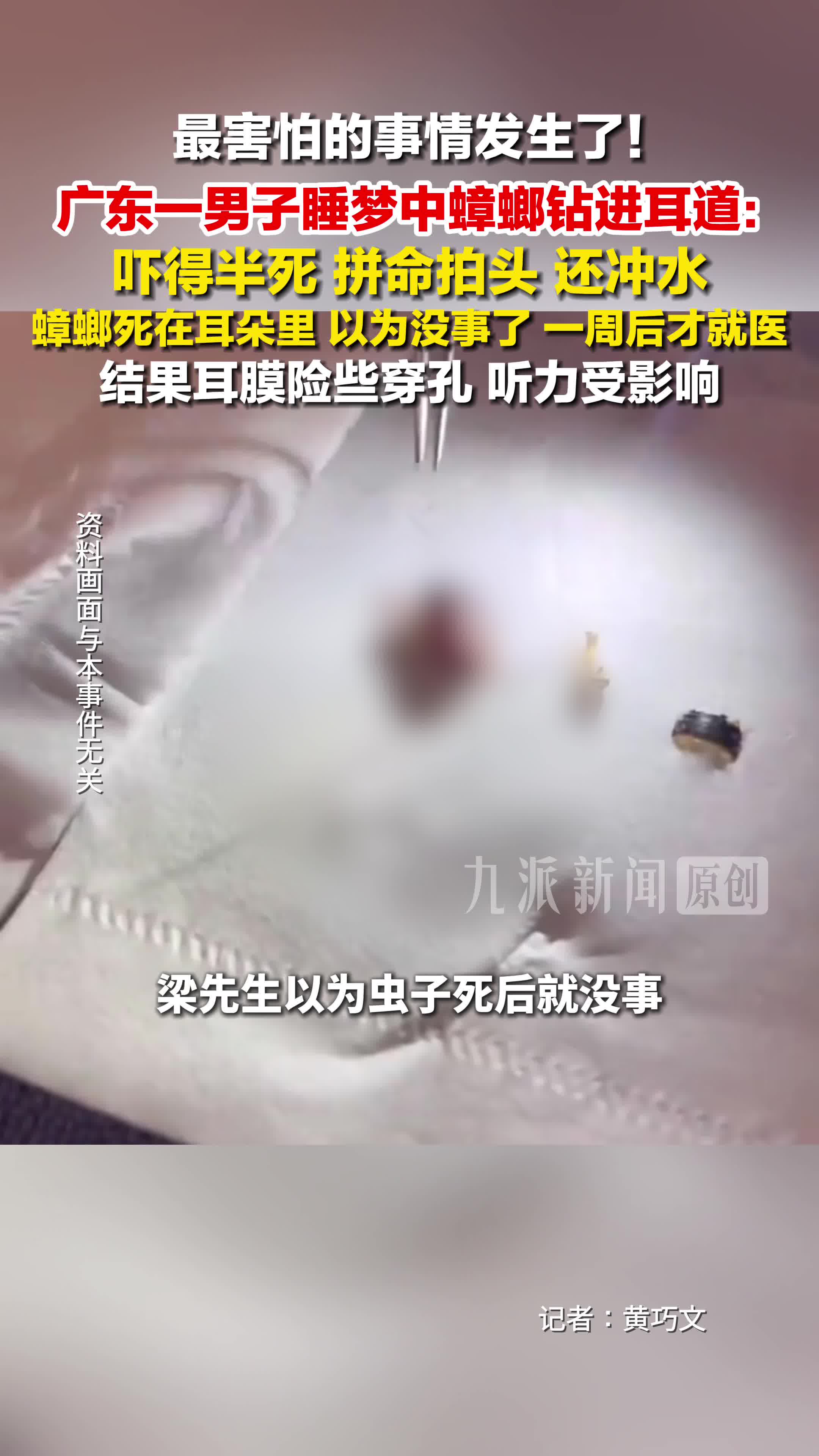 男子睡梦中蟑螂钻进耳道 ：拼命拍头还冲水，一周后才就医，结果耳膜险些穿孔。