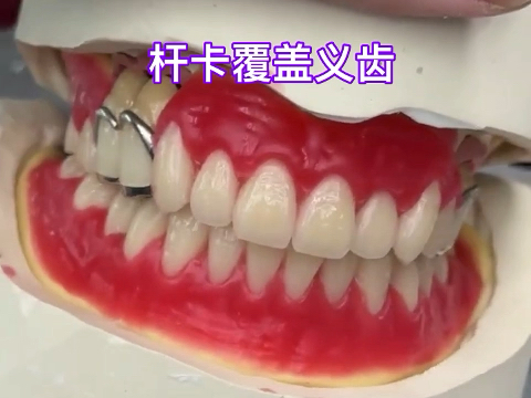 杆卡覆盖义齿+钢托排牙by JD dental lab#覆盖义齿#牙匠之家哔哩哔哩bilibili