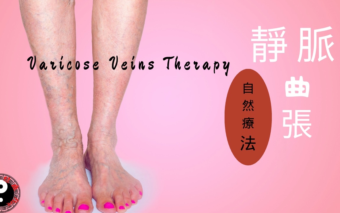 natural therapy in the treatment of varicose veins