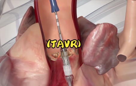 [图]Edwards SAPIEN 经导管主动脉瓣置换术 (TAVR) 经股动脉手术动画