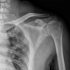 病例分享——肩胛骨喙突基底部隐匿性骨折