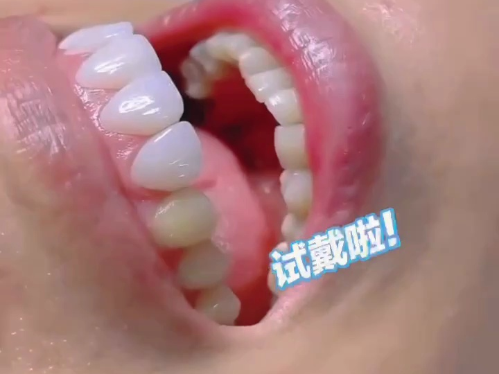 牙齿美学瓷贴面 试戴,感觉一下子就来了!