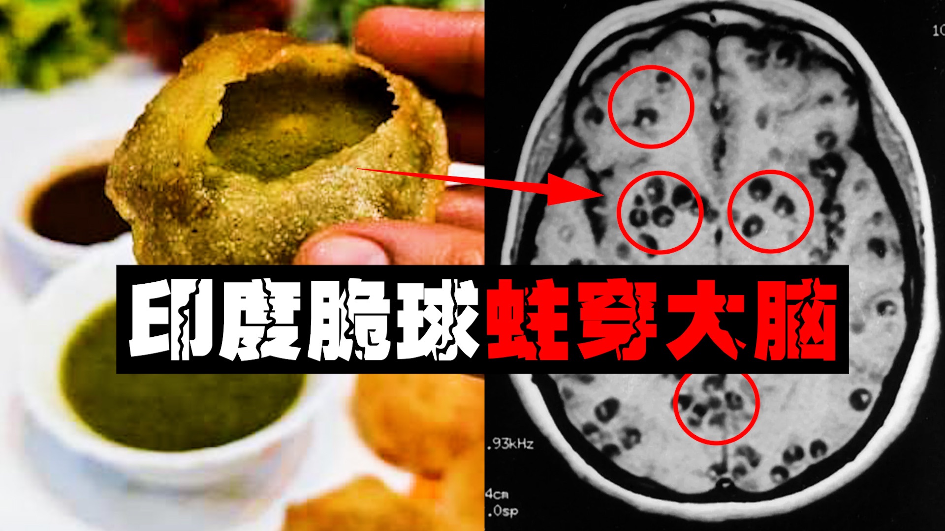 【人脑虫巢】印度回来44天脑里发现虫卵，这是他吃完脆球身体发生的变化。。。。海报