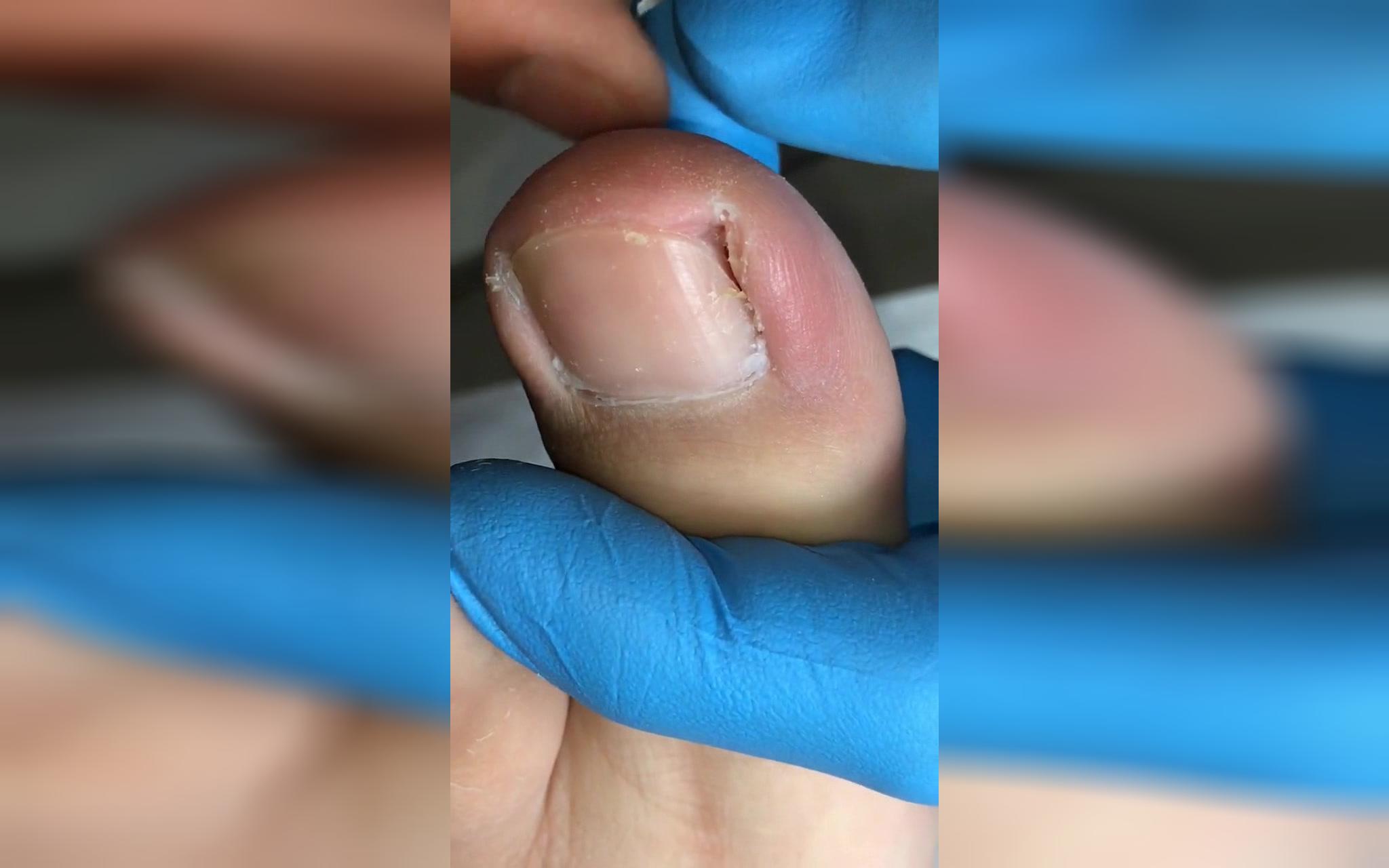 high-tech pull out ingrown toenail,輕微甲溝炎,拔出嵌甲真的超爽