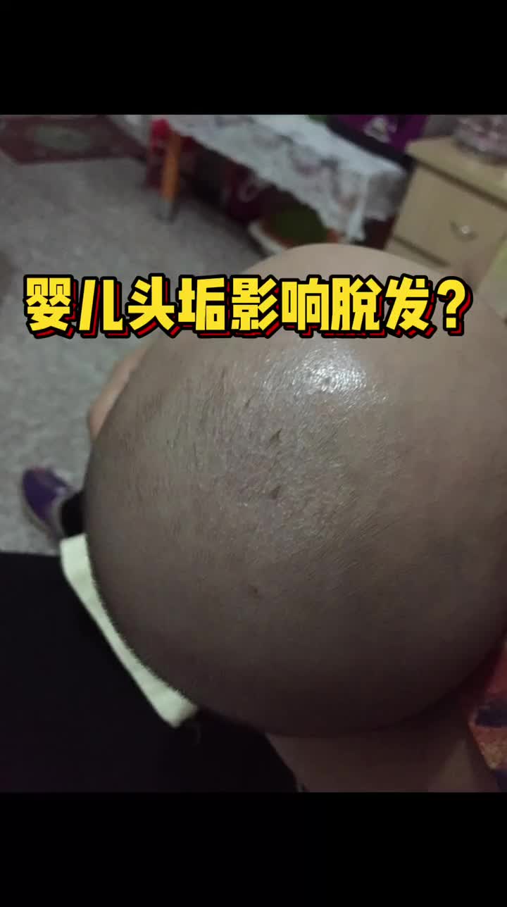 婴儿头垢影响毛发吗 头发 医学科普哔哩哔哩bilibili