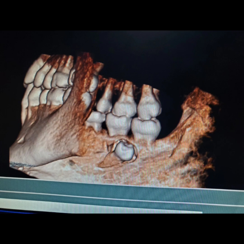 疼了我三四个月的阻生埋伏牙,把我的大牙牙根都顶坏了,但是终于感觉如