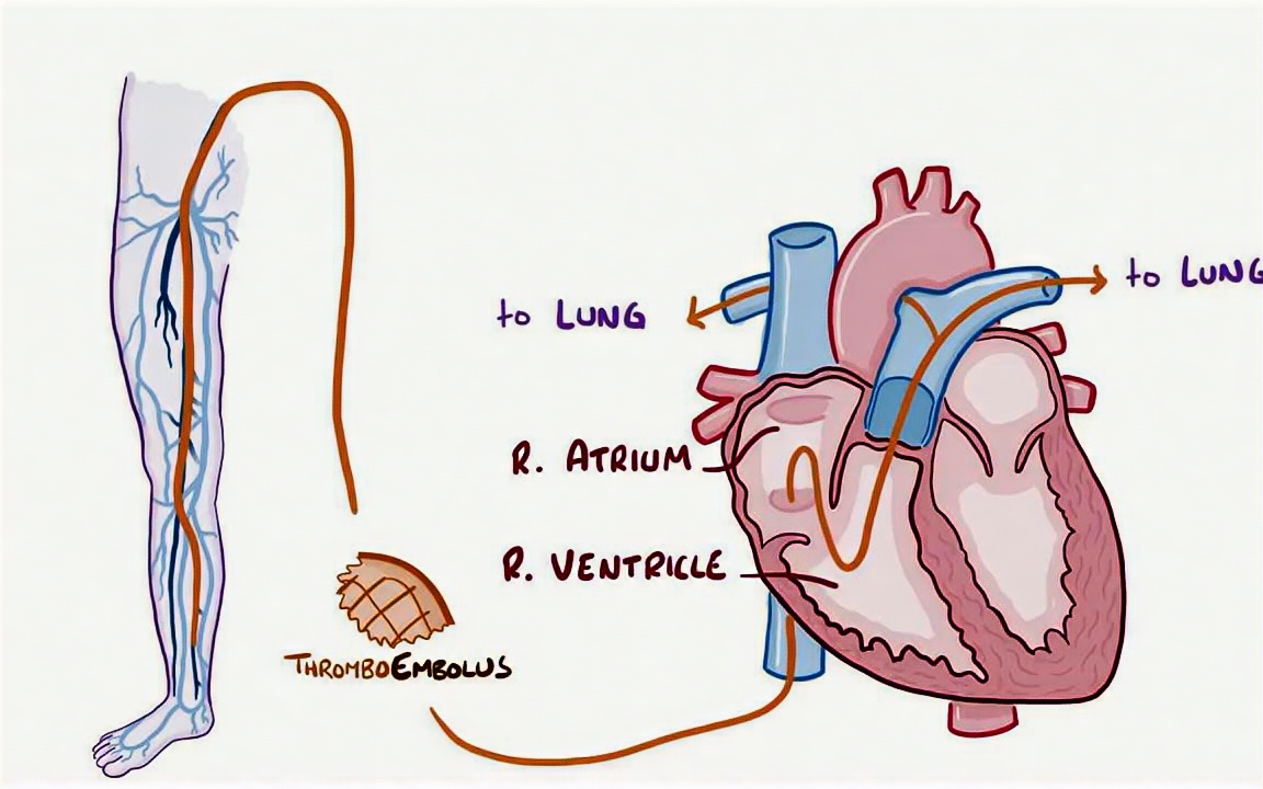 coronary thrombosis图片