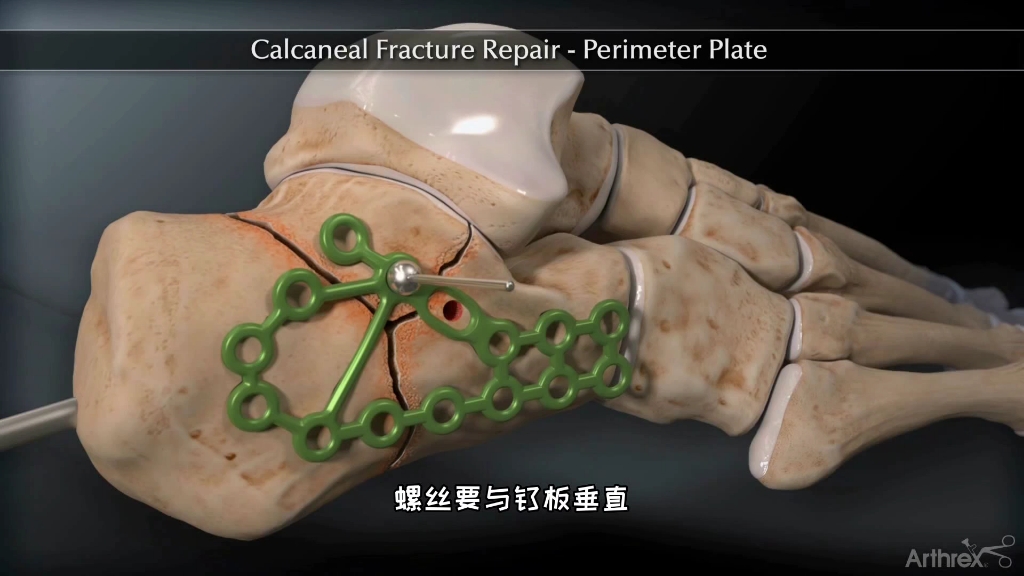 脚跟骨骨折手术修复过程,3D演示..哔哩哔哩bilibili