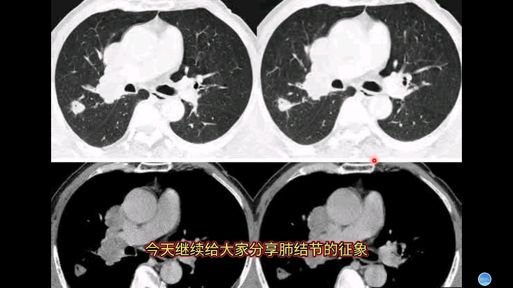 肺结节的“空泡征”在CT上什么表现?和空洞有何区别?哔哩哔哩bilibili