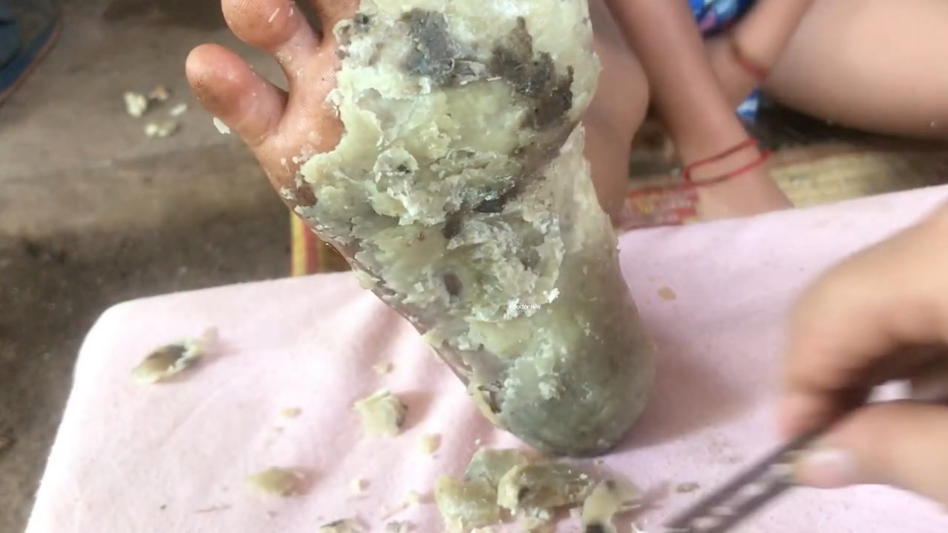 脚底死皮脚蜡,看下怎么刮除干净