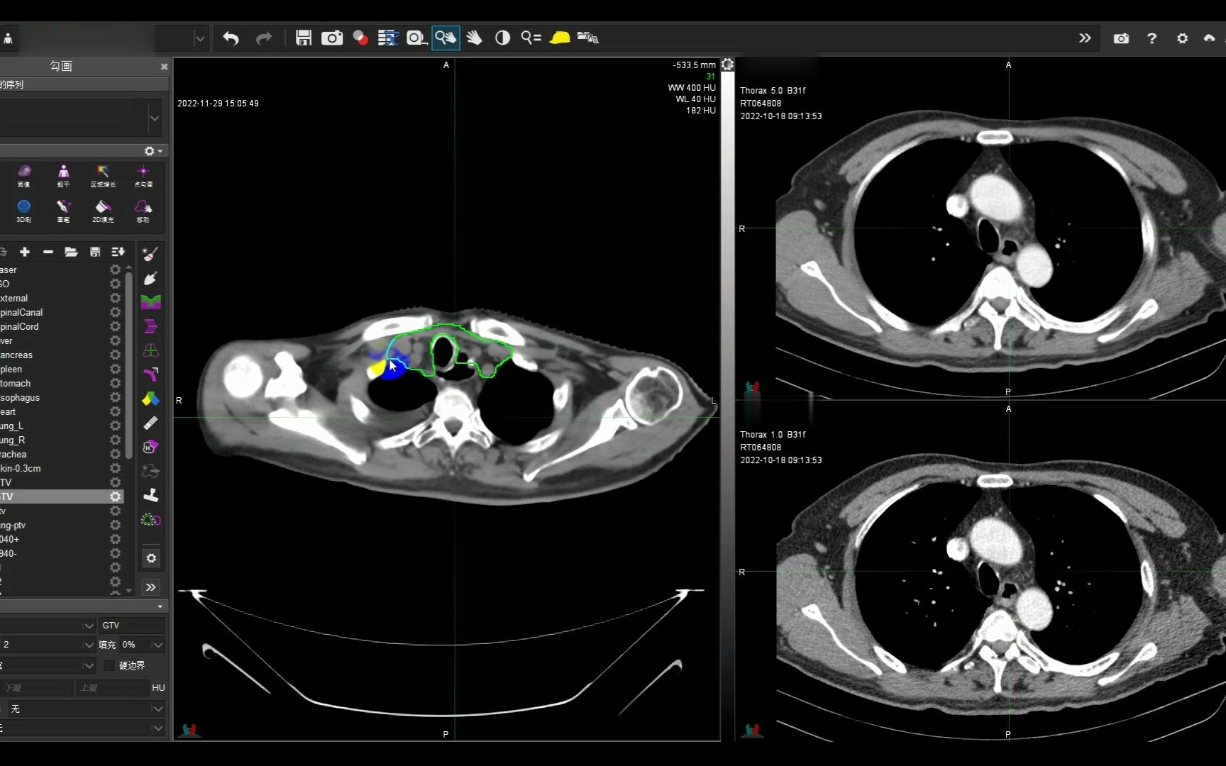 食管癌术后放疗靶区勾画
