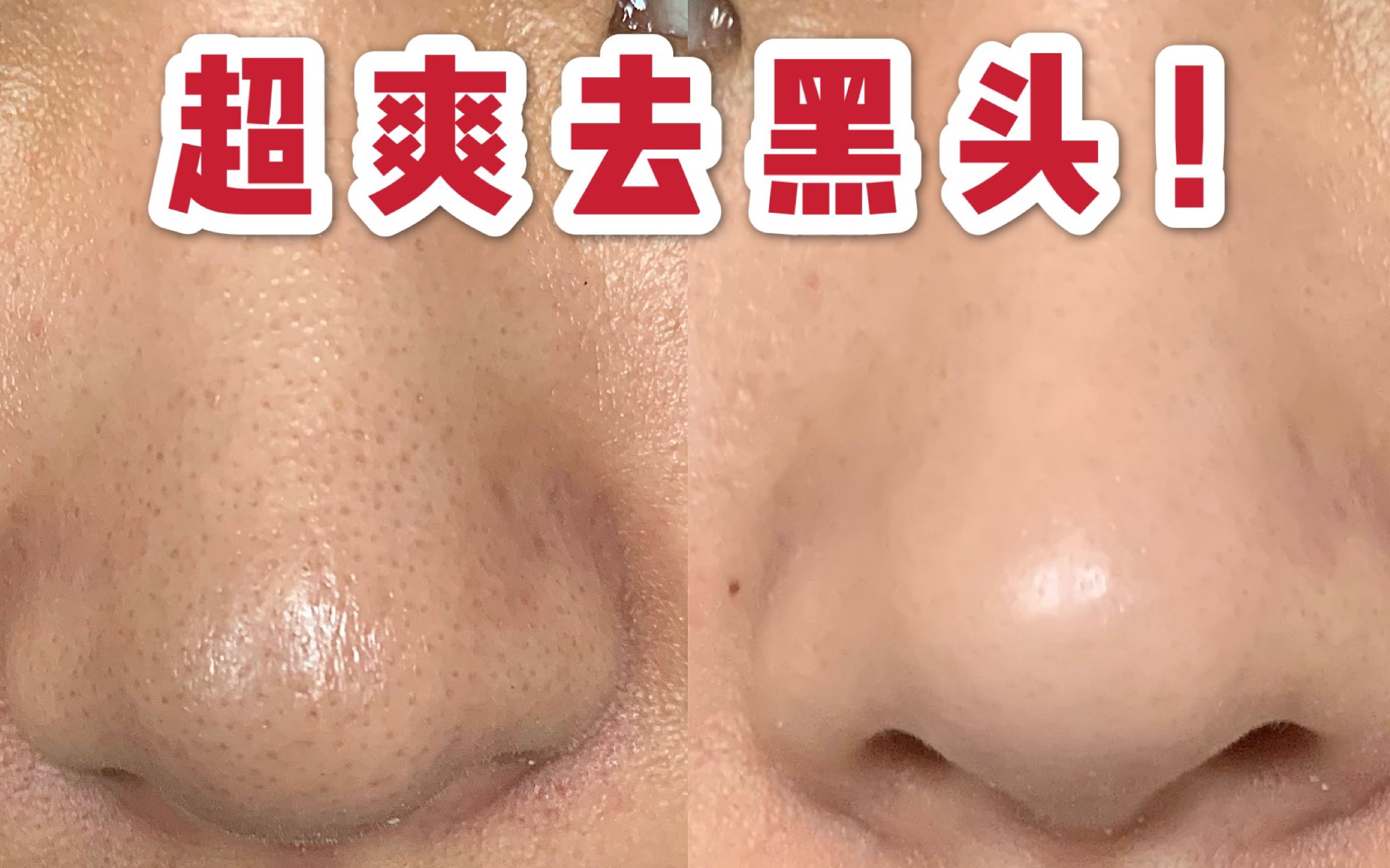 活动  显微镜下5分钟轻松吸黑头|恶意又满足|密恐慎入