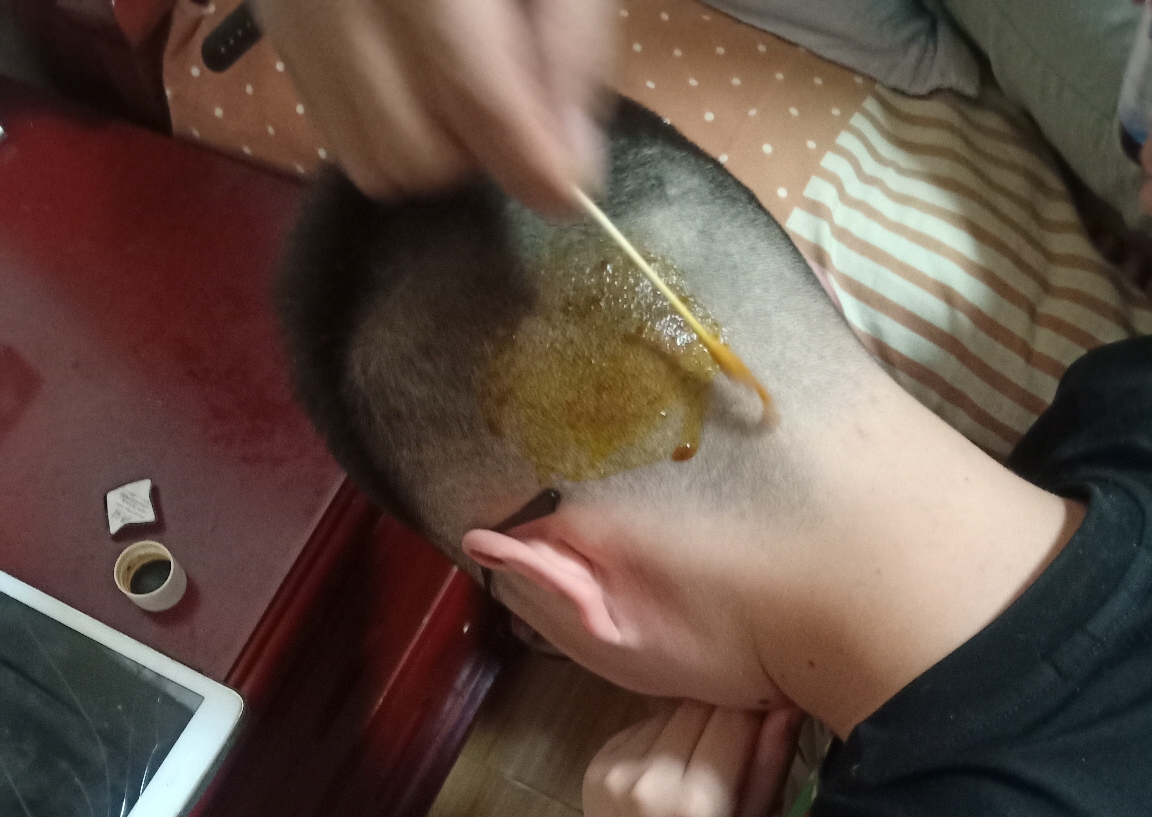 我哥哥可真惨头烂了一大片 其实就是头皮屑烂在头皮上了