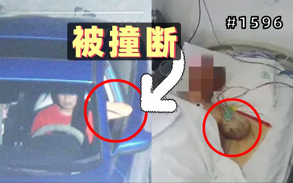 小伙开车喜欢把手搭在窗外，结果被货车刮到截肢！【1597期】
