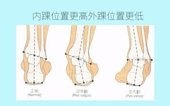 【每日科普】足弓高的人更加容易崴脚!崴脚的经历你有过吗?哔哩哔哩bilibili