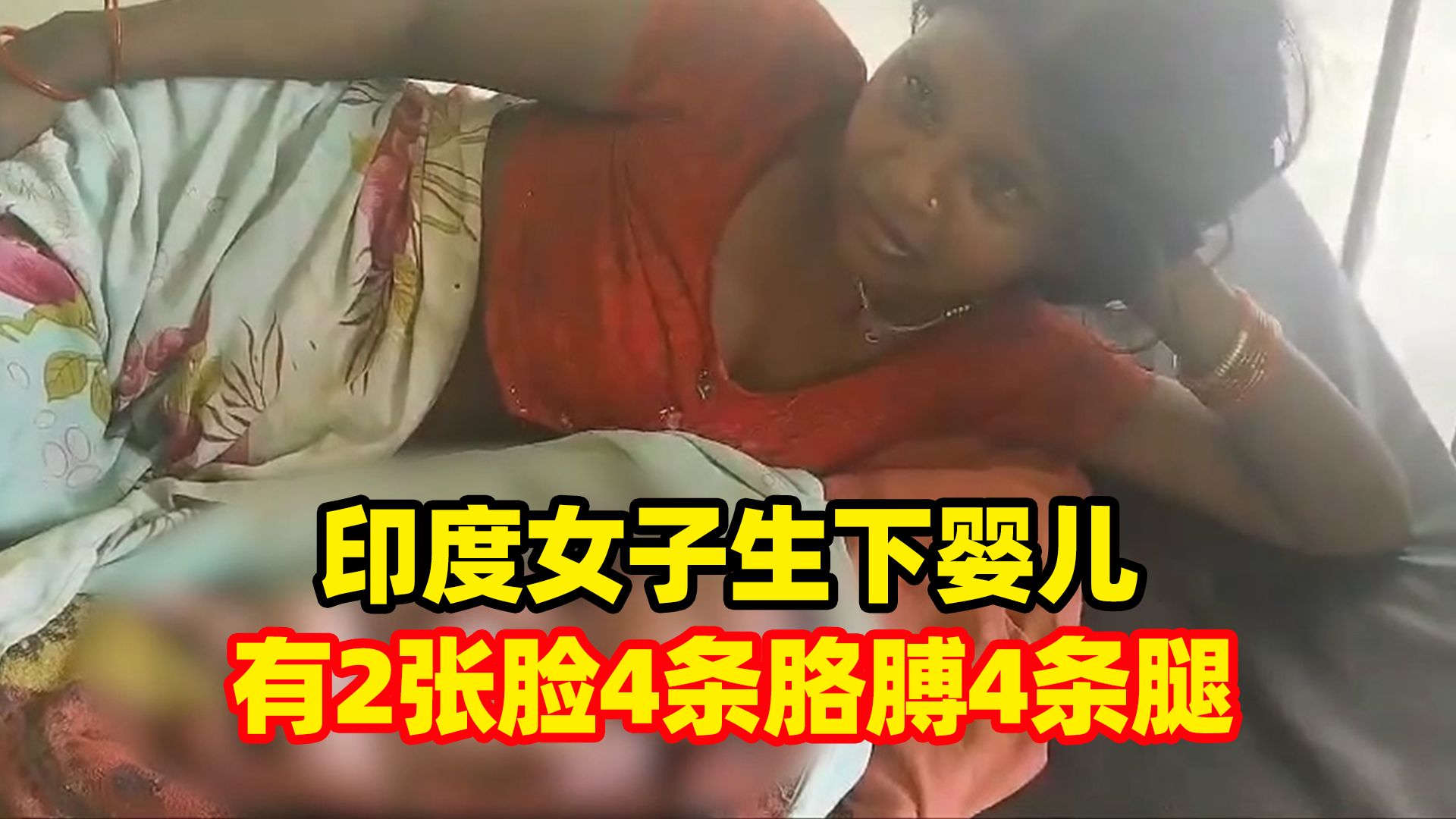 印度38岁女子生下婴儿:有2张脸4条胳膊4条腿,出生5小时后夭折哔哩哔哩bilibili