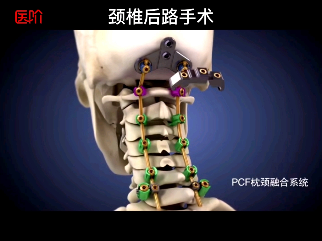 颈椎后路手术是对于多节段颈椎病所采取的一种有效的颈髓神经减压方法.哔哩哔哩bilibili