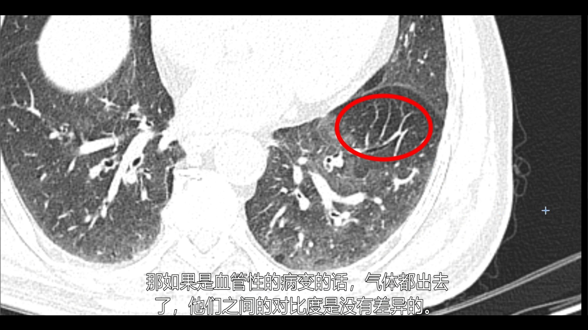 CT入门教学(18):胸部CT马赛克征象如何分析?哔哩哔哩bilibili