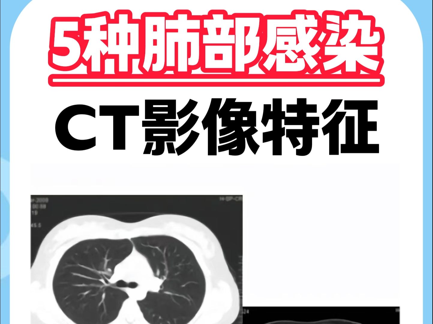 5种肺部感染ct影像特征